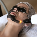 láser tratamientos faciales