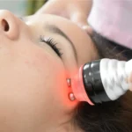 lifting facial sin cirugía