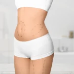 lifting corporal sin cirugía