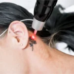 riesgos del láser para eliminar tatuajes