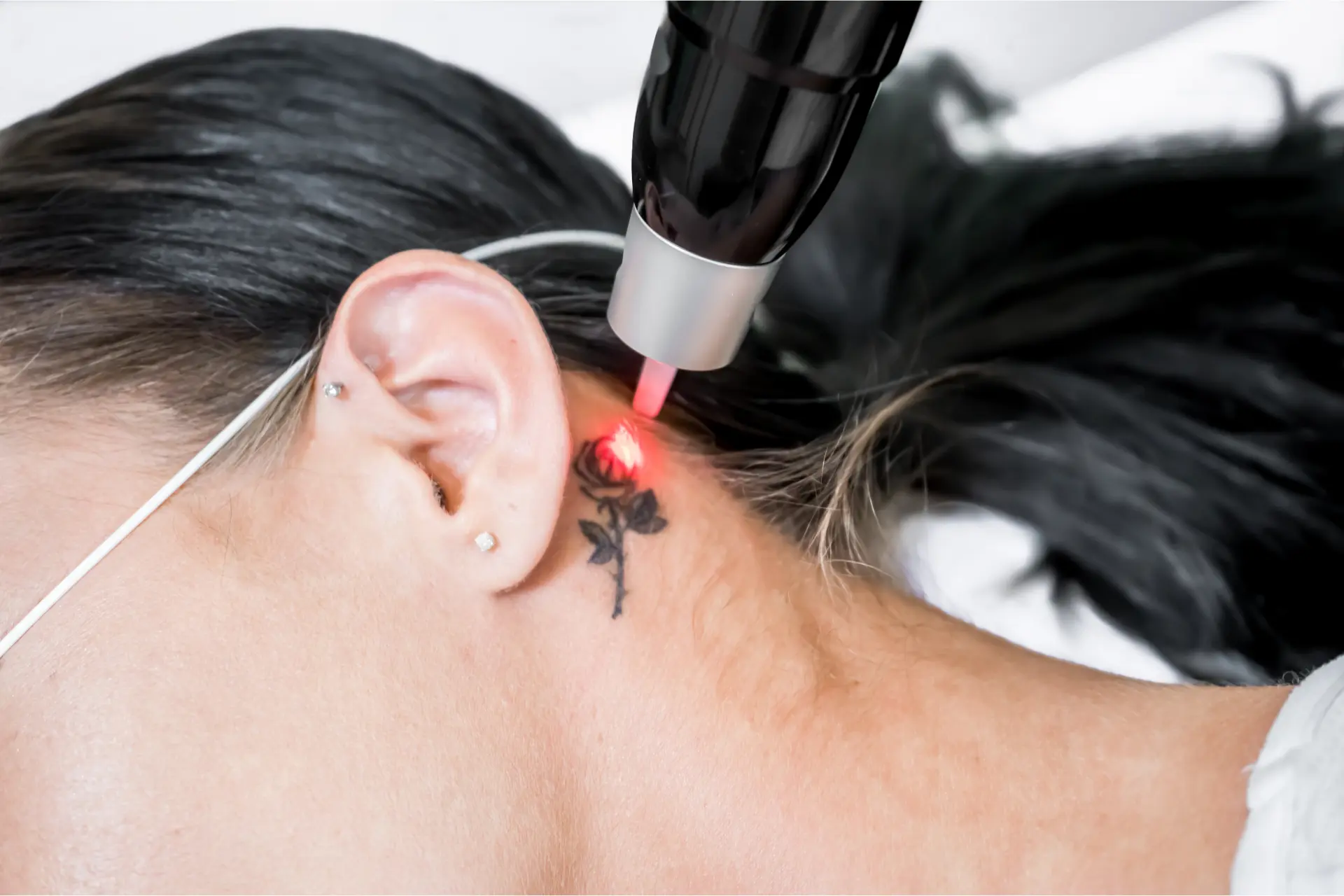 riesgos del láser para eliminar tatuajes