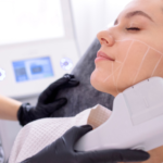 Duración efecto HIFU