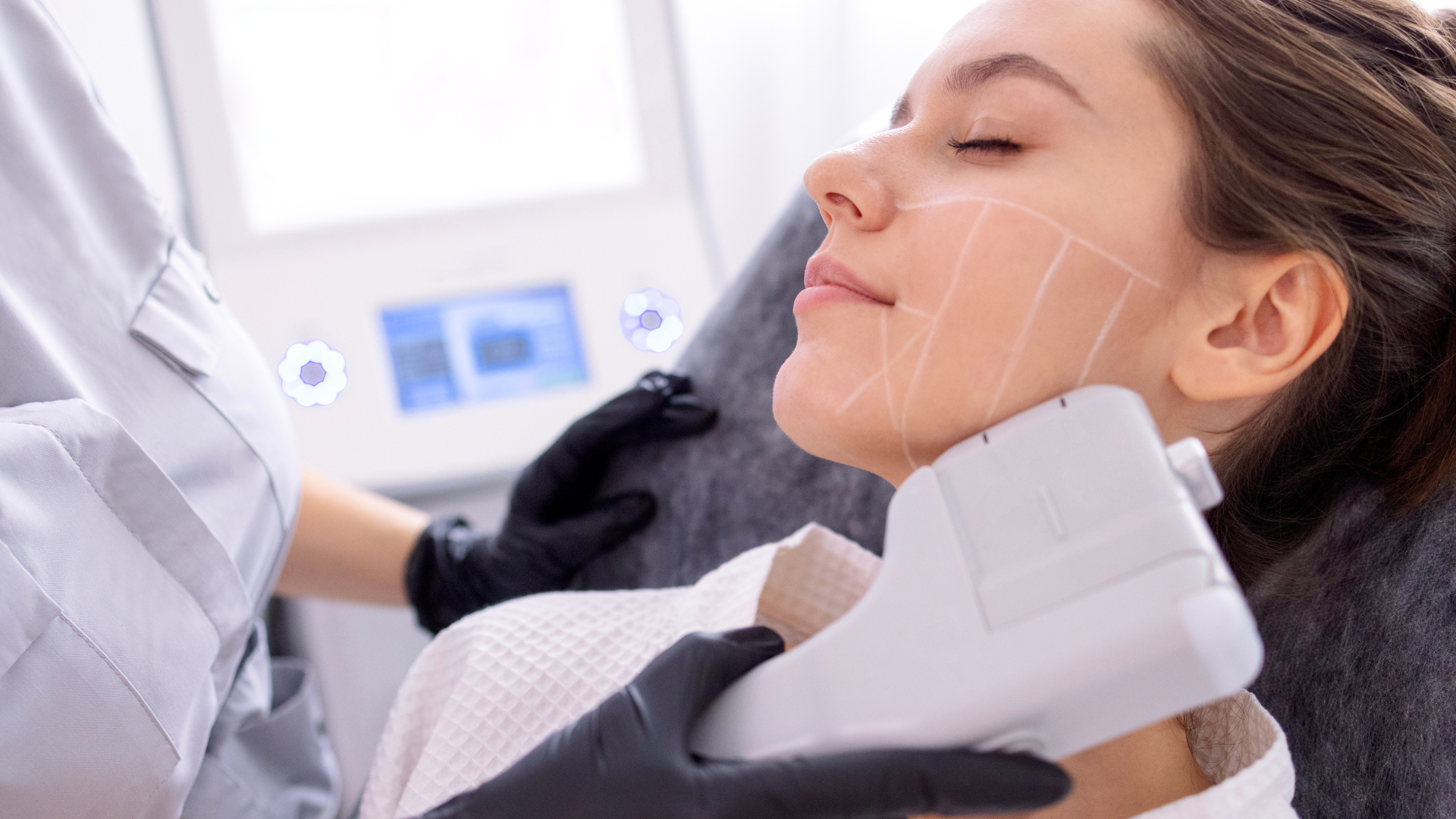 Duración efecto HIFU