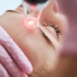 láser despigmentante